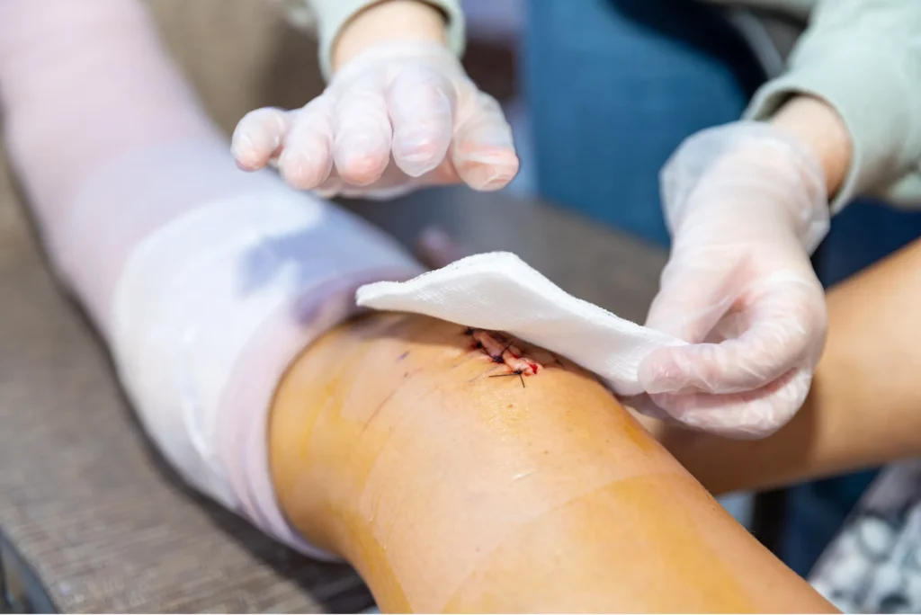 Qué esperar en la primera semana tras cirugía de rodilla